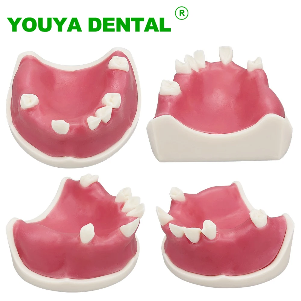 

Dental Implant Model Teeth Restoration Teaching Study Model Typodont With Soft Gums Dentistry Practice Demonstration Models