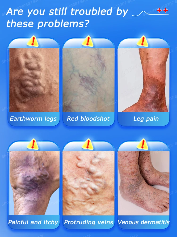 Ручка Varicosse Blu-ray Skin Cream