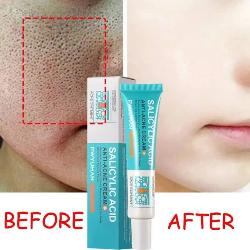 Крем для сужения пор с салициловой кислотой быстрое устранение больших удаление