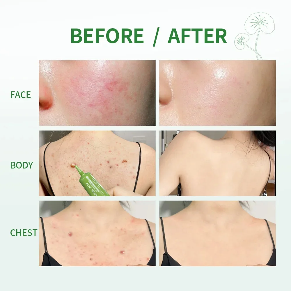 Рисунок 3 - Эффективное средство для лечения акне