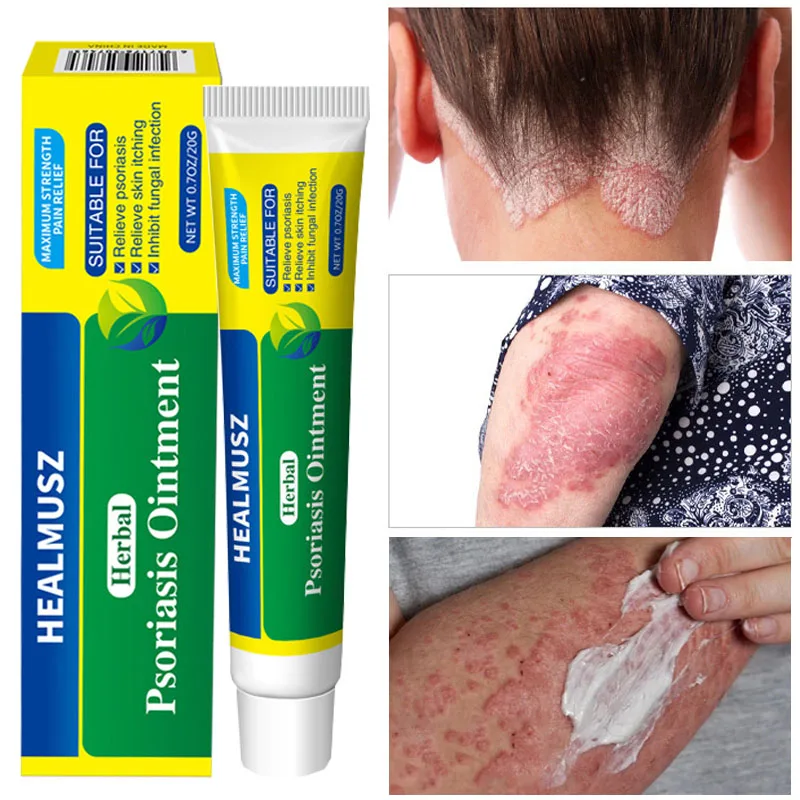 Psoriasis Effective Anti-itch Cream Antibacterial Treatment Dermatitis Itching Eczema Urticaria Desquamation Body Skin Care 20g