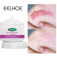 acne scar removal cream fade repair burn surgery scar stretch marks smoothing moisturizing damaged body skin care