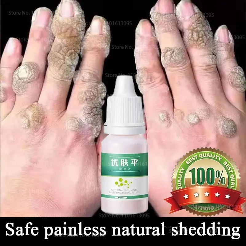 

Skin Tag Mole Wart Removal Buang Ketuat Kutil Essential Ubat Buang Tahi Lalat Kutil Biji Kolesterol Ketuat Krim