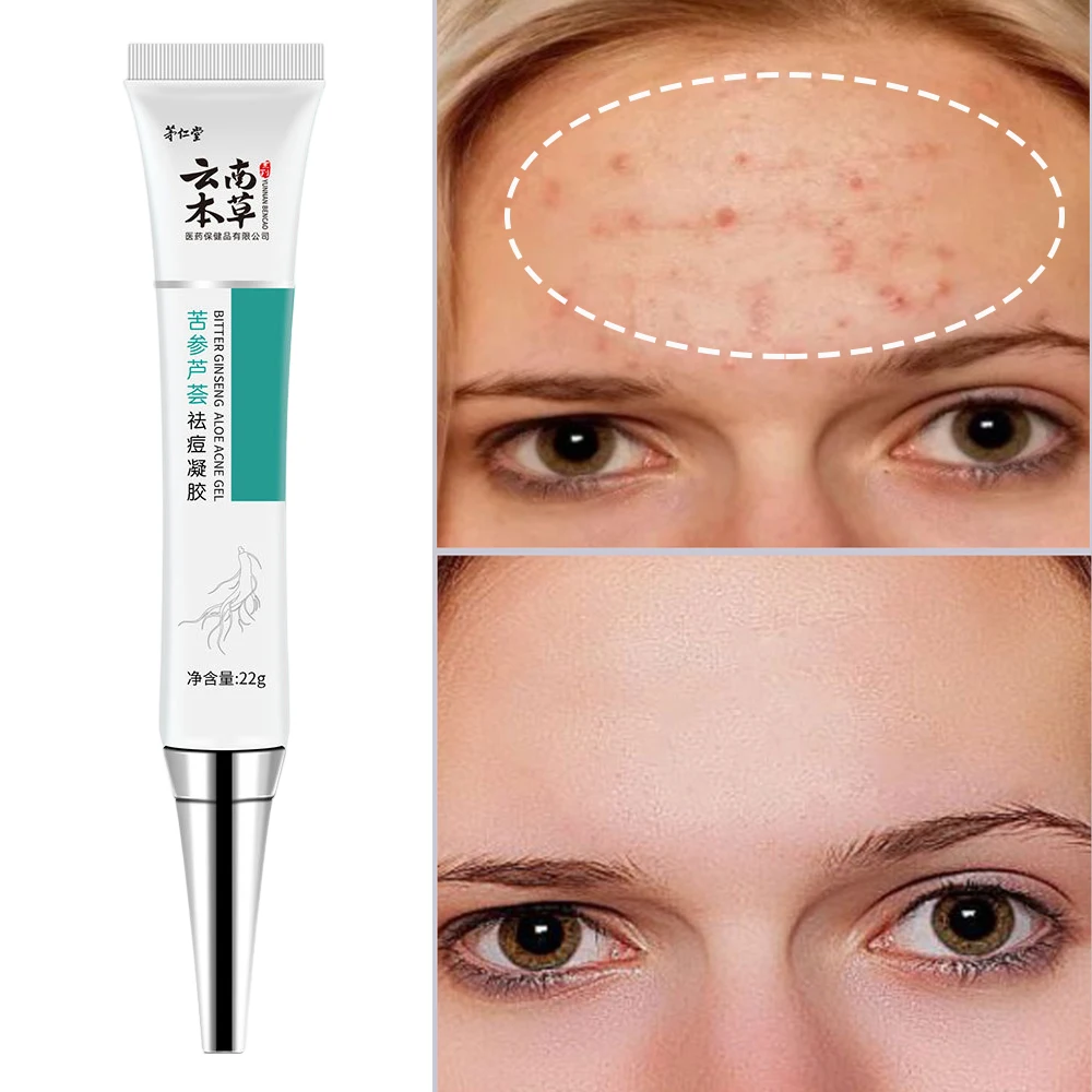 

Herbal Acne Removal Facial Cream Clears Pimples Scar Black Dots Gel Treat Oil Control Severe Acne Shrink Pore Skin Care Ointment