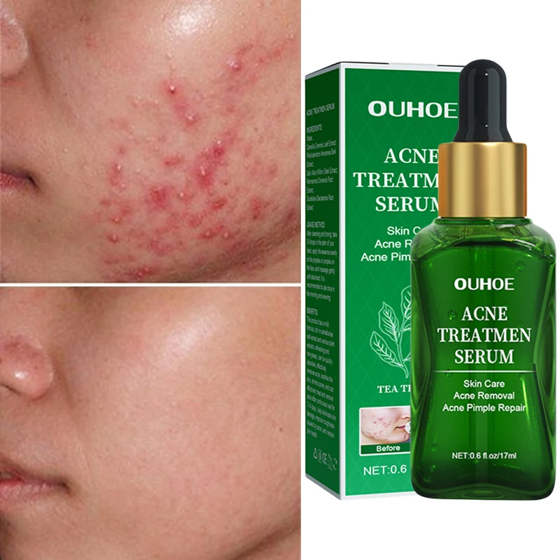 

Herbal Acne Treatment Cream Pimple Spot Removal for Teens Oil Control Acne Scar Gel Shrink Pores Face Skin Care Beauty Health