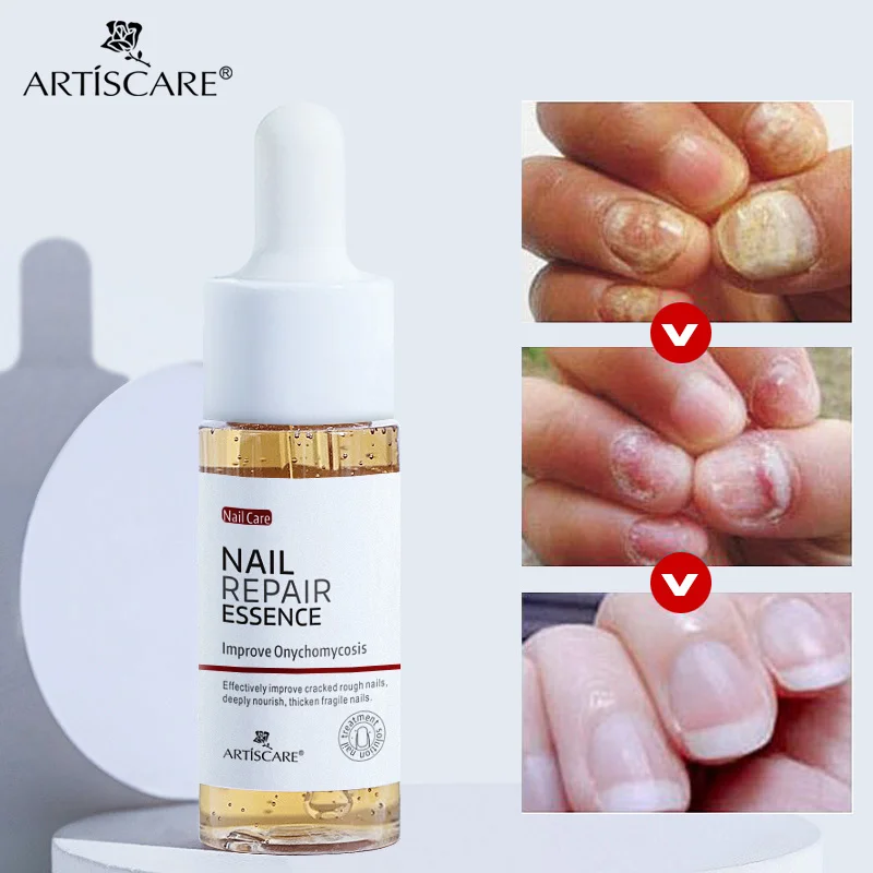 

Эссенция ARTISCARE для восстановления ногтей, Сыворотка от грибка, Лечение ногтей, удаление онихомикоза, питание, осветление рук, ног, уход за но...