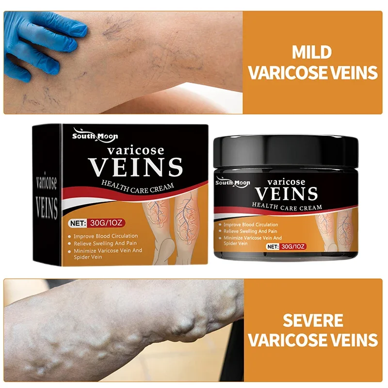Крем для лечения варикозного расширения вен восстанавливает боль в ногах