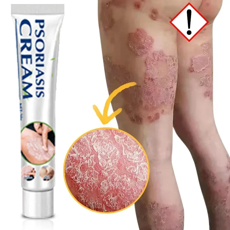 Увлажняющий крем от псориаза натуральный Восстанавливающий Антибактериальный