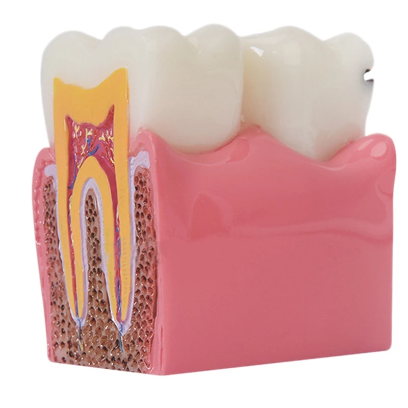 

Teeth Model Materials Lab Teeth Model 6Times Caries Comparation Study Models For Dentist Studying And Researching
