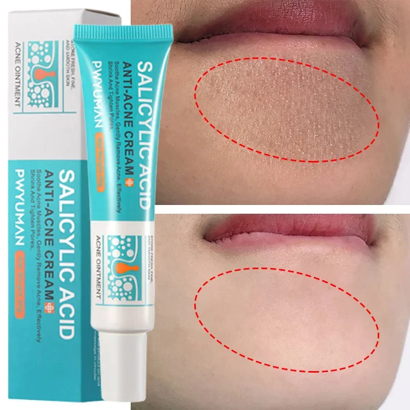 Ночной крем с салициловой кислотой Очищающий поры Отшелушивающий гель для