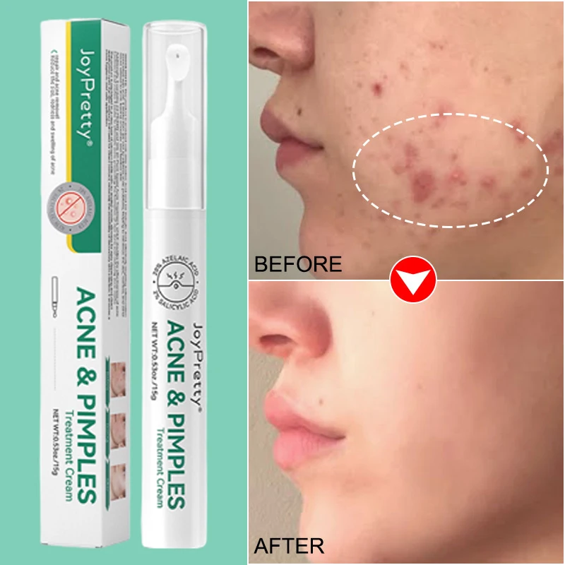 

Salicylic Acid Herbal Acne Treatment Cream Pimple Spot Removal For Teens Oil Control Acne Scar Gel Shrink Pores Skin Care Beauty