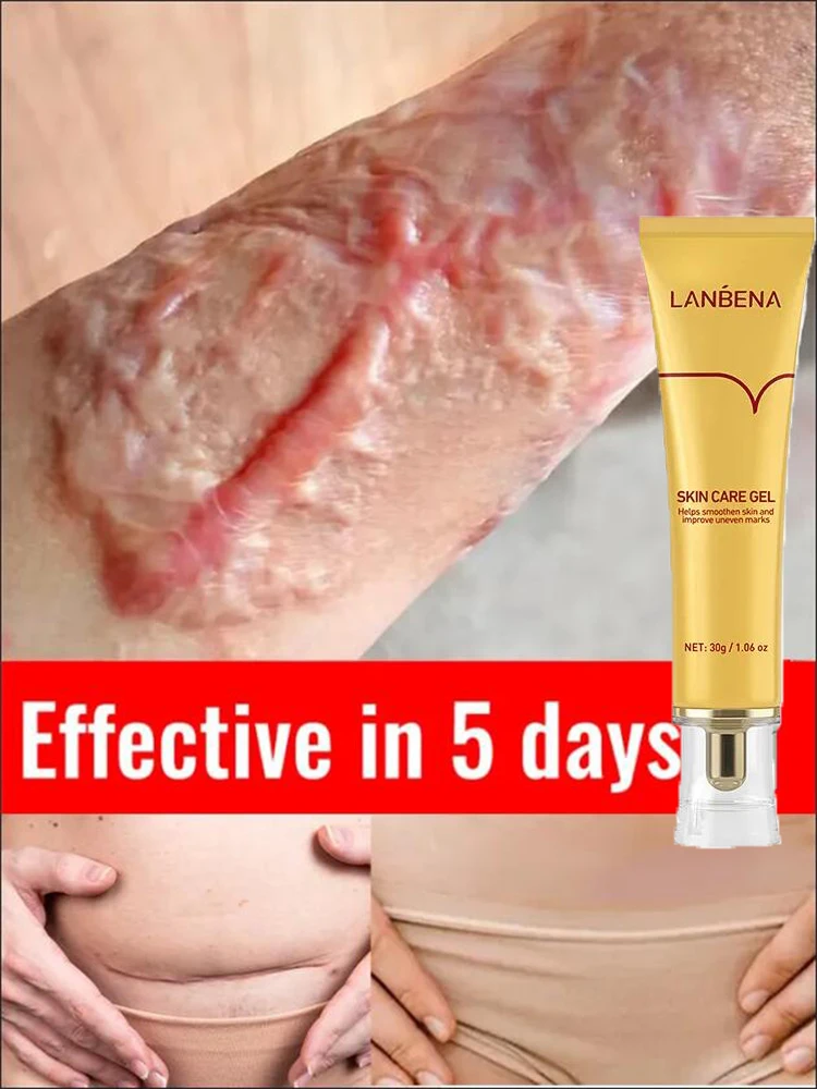 

LANBENA Scar Removal Cream Remove Acne Spots Treatment Stretch Marks Burn Surgical Scars Repair Gel Whitening Beauty Skin Care