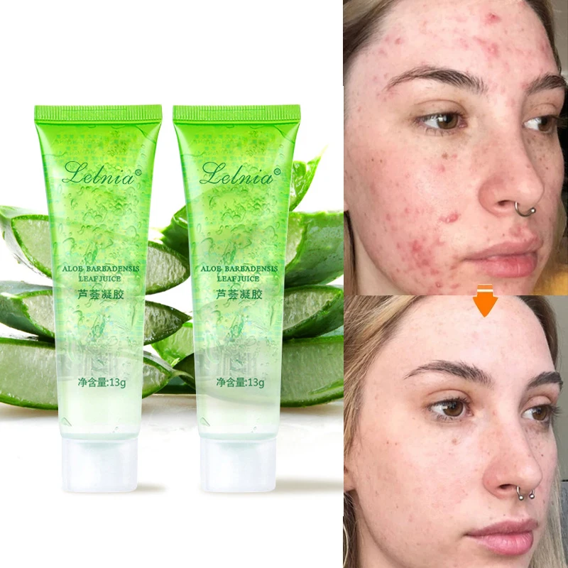 

Aloe Vera Acne Scar Removal Cream Acne Spots Burn Gel Surgical Scar Treatment Moisturizing Whitening Scar Removal Gel Skin Care