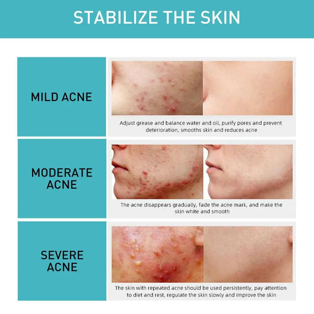 Крем для удаления веснушек 50 г корректор темных точек осветление пигментации