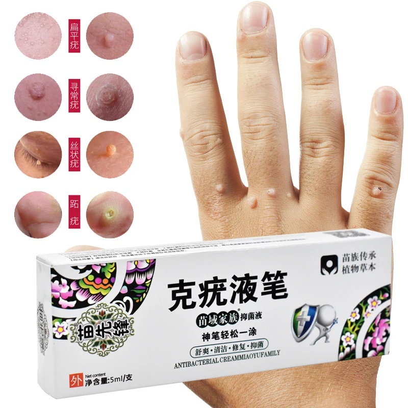 

5 мл Высококачественная ручка для удаления бородавок, этикетка для кожи, крем для удаления бородавок, плоских бородавок, гениталий, бородавок, корней, медицинский пластырь