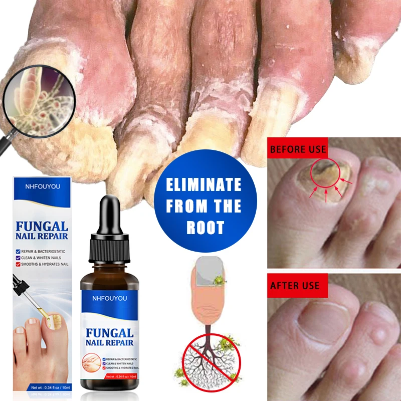 

Fungal Nail Treatment Oil Foot Repair Essence Toe Nail Fungus Removal Gel Anti Infection Cream Fungal Nail Removal 10ML