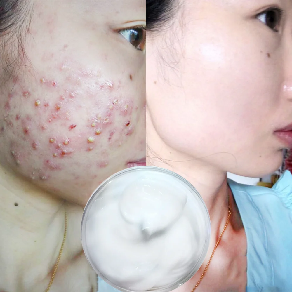 

Herbal Acne-treatment Cream Remove Acne Fade Acne Marks and Pits Oil-control Shrinking Pores Skin Acne-treatment Care Products