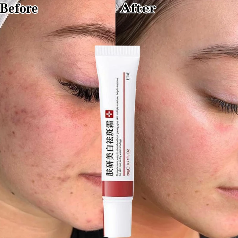 

20ml Whitening Freckle Cream Remove Melasma Cream Remove Freckles Remove Dark Spots Melasma Remover Brighten Skin Anti-Aging