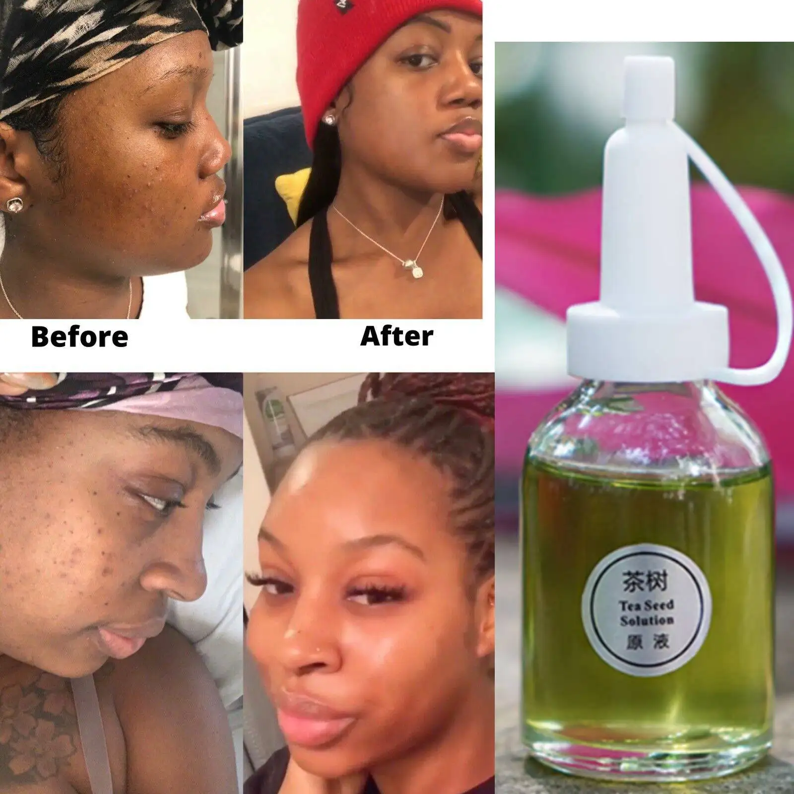 

30ml Green Tea Face Mask Oil Control Acne Dark Spot Scars Blemishes Removal CLARIFYING ACNE TREATMENT FACE OIL Promotion