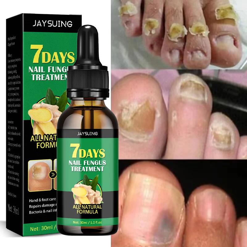 

Ginger Nail Fungal Treatment Serum 7 Days Onychomycosis Care Essence Anti Infection Paronychia Foot Toe Nail Fungus Removal Gel