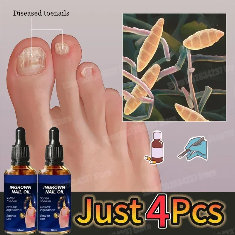 Средство для ухода за ногтями грибковая эссенция ногами против инфекции