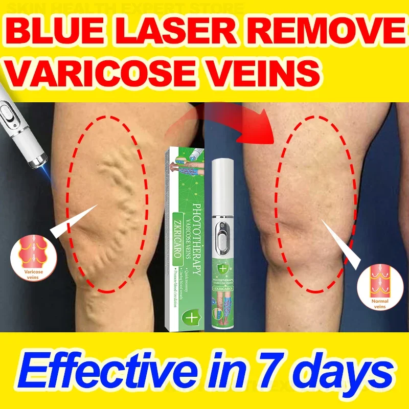 Лазерная терапия для лечения варикозного расширения вен | AliExpress