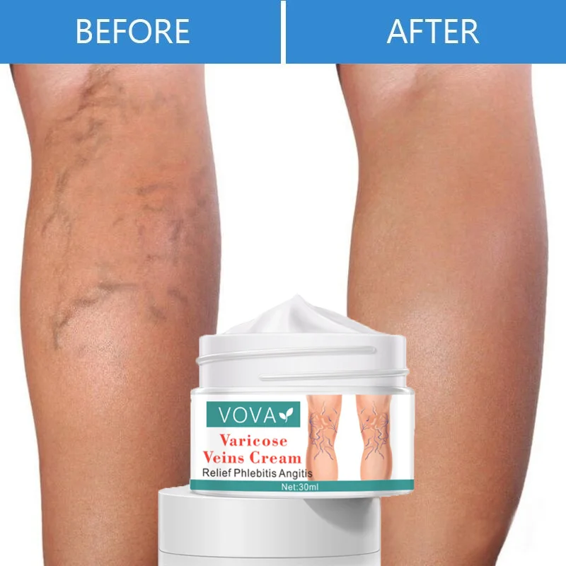 Effective Varicose Veins Relief Cream Vasculitis Phlebitis Spider Pain Treatment Ointment Relief Leg Tired Repairing Body Care