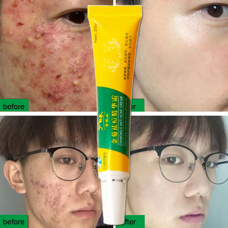 

Herbal Chamomile Acne Removal Cream Skin Care Acne Traditional Chinese Medicine Treatment Facial Cream No Stimulation 20g