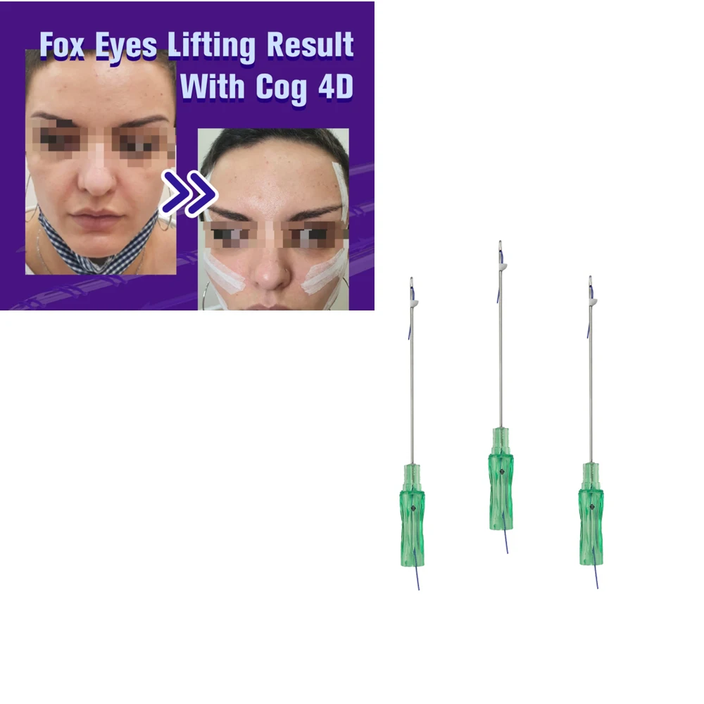

NOW Korea sterile v-line face twist mono barbed pdo nose lift thread tornad Cog 3d 4d 6d PDO Thread