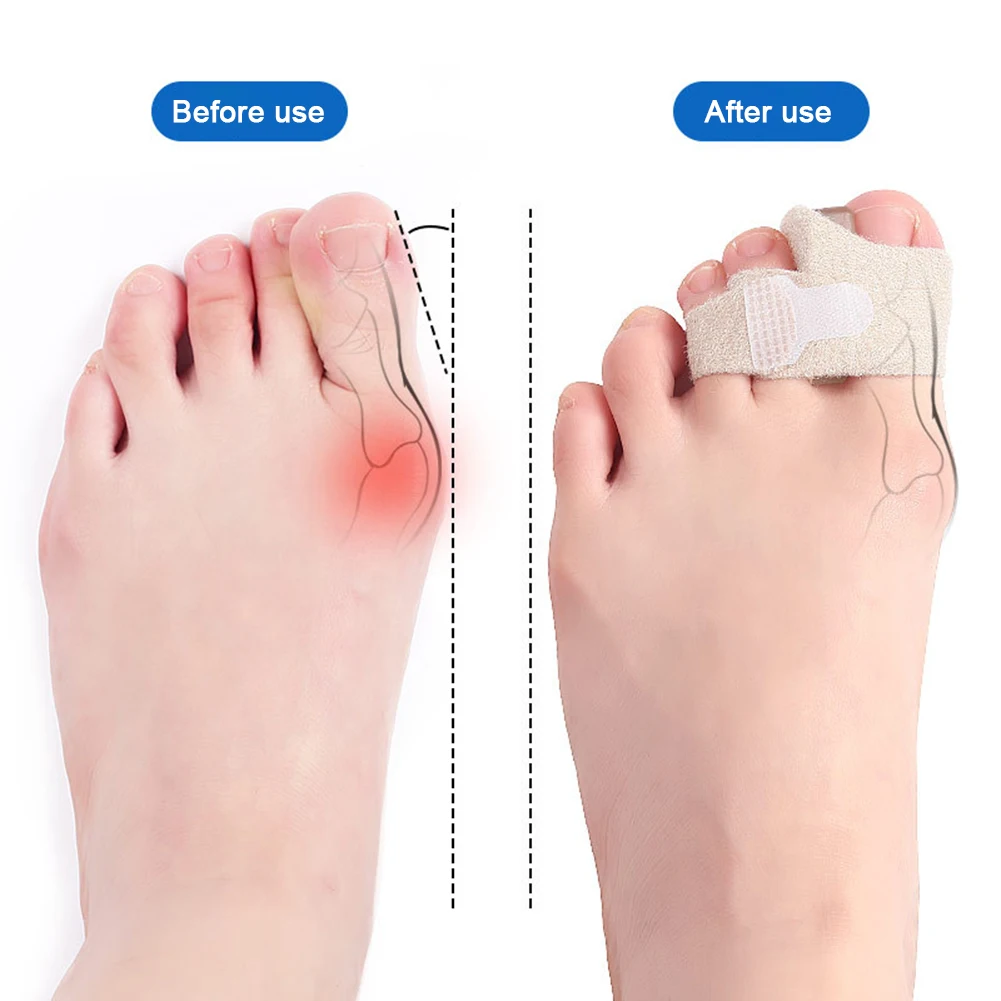 

1Pc High Quality Toe Spreader Separator Bunion Hallux Valgus Corrector Thumb Finger Correction Straightener Foot Care Tool