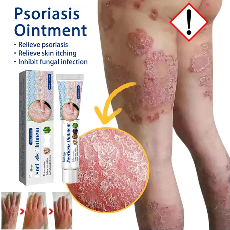 

Psoriasis Cream for Skin Ointment Dermatitis Creams Eczematoid Pruritus Herbal Anti-Itch Antibacterial Health Skin Care Products