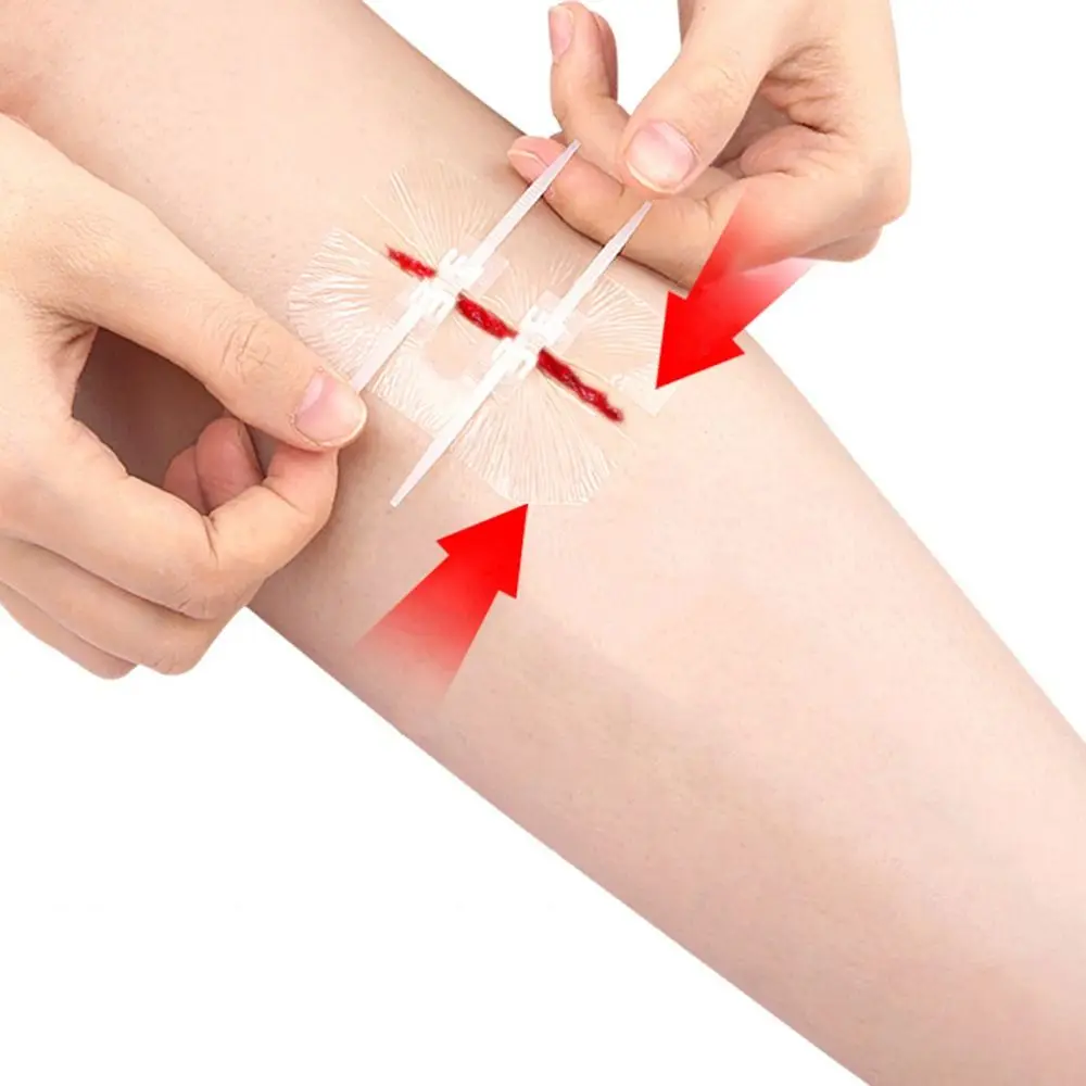 Клейкая повязка на молнии для ухода за ранами помощь при первой помощи ремонт без