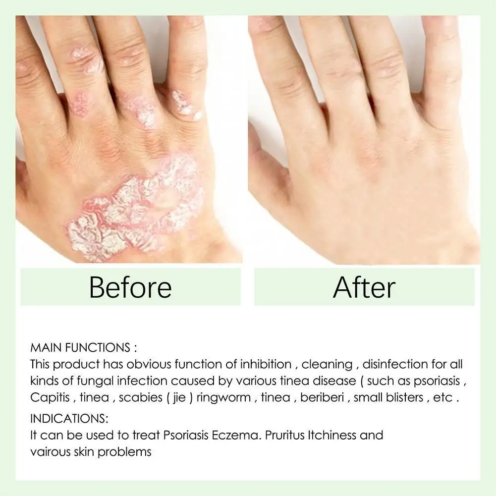 

30g Dermatitis Skin Eczema Psoriasis Cream Allergic Neurodermatitis Chinese Medicine Healthy Care Ointment