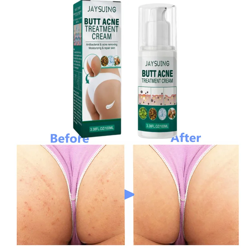 

Средство для очистки ягодиц и прыщей, 100 мл