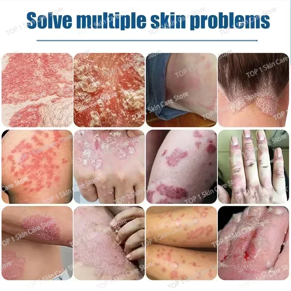 Китайская Антибактериальная мазь на основе лекарственных трав при псориазе Eczma