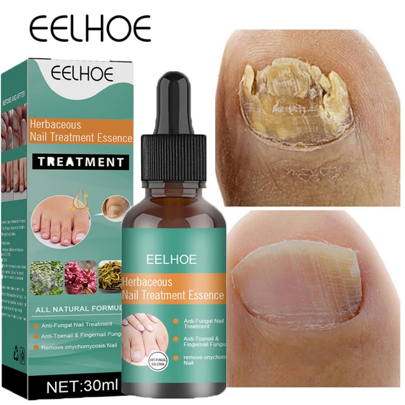 

Nail Fungus Treatment Repair Essence Herbal Anti-Infection Toe Nails Foot Fungal Removal Serum Paronychia Onychomycosis Care Gel