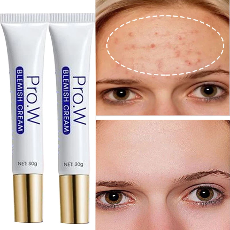 Acne Removal Face Cream Anti-age Gel Treatment Scars Oil Control Eliminate Pimples Whitening Moisturizing Shrink Pores Skin Care