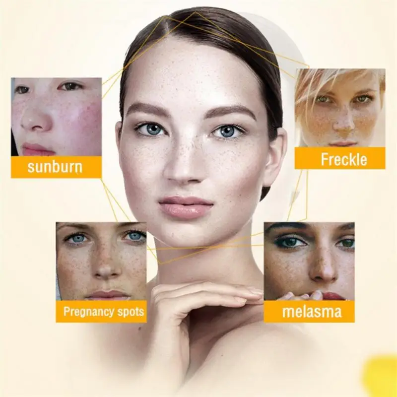 

IBeaLee Whitening Freckle Cream Remove Dark Spots Remove Melasma Anti Freckle Cream Fade Pigmentation Anti-Aging Light Skin Care