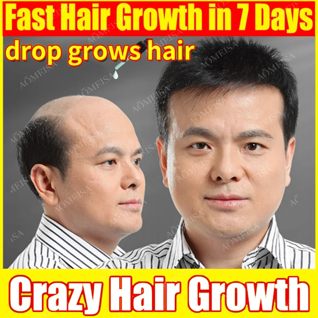 Fast Hair Growth Hair Follicle Treatment Hair Growth Seborrheic Alopecia Hairline Upward Postpartum Hair Loss Baldness Hair Loss 1