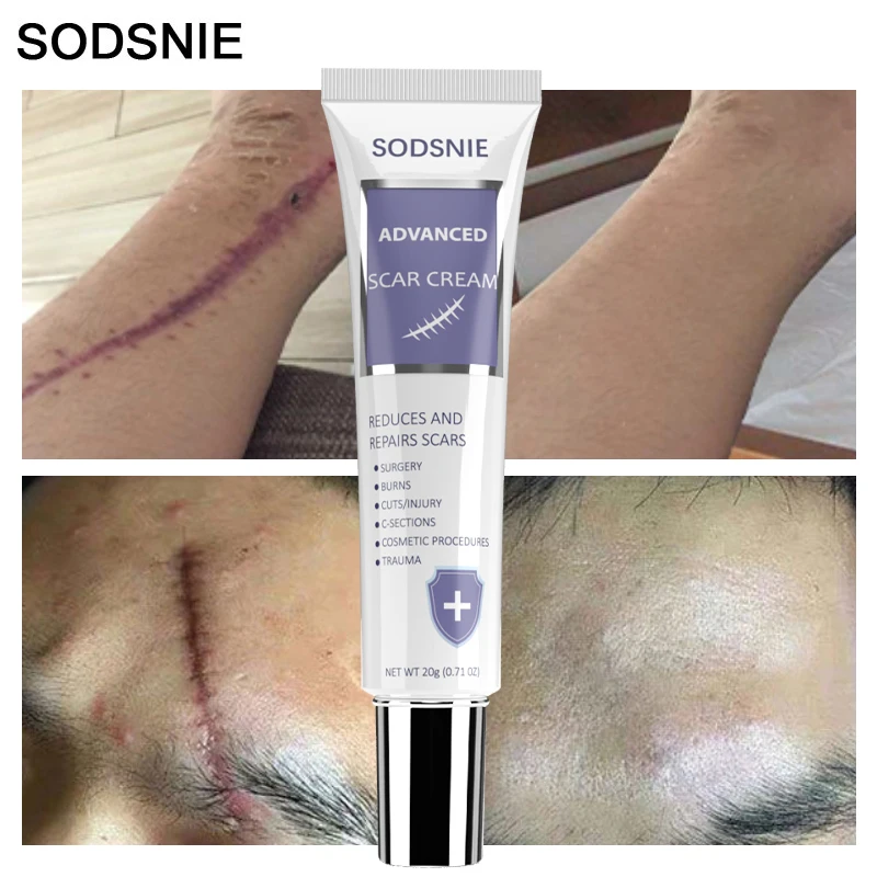 

Advanced Scar Cream Removal Acne Spots Burn Scars Treatment Smoothening Moisturizing Body Skin Care Whitening Repair Nourish 20g