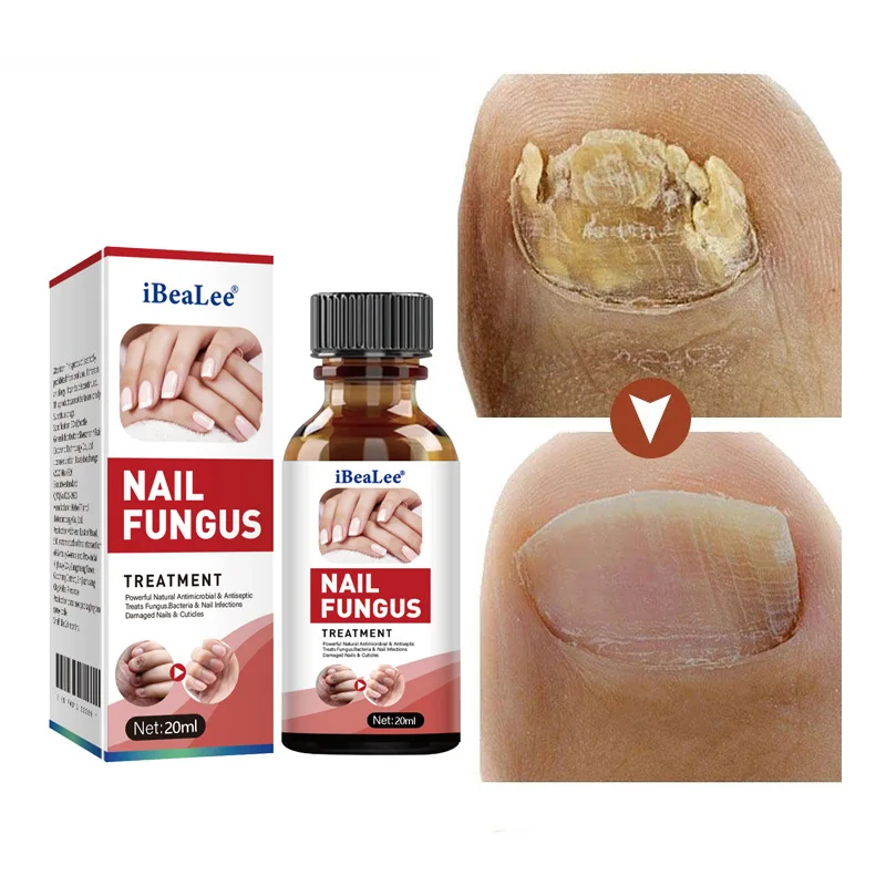 

Fungal Nail Treatment Serum Treat Onychomycosis Paronychia Anti Infection Essence Toe Nail Fungus Brightening Feet Care Products