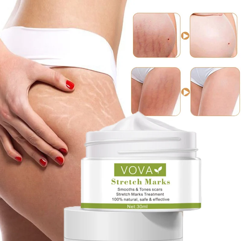 

Крем Для Удаления растяжек после родов ожирение беременных женщин Восстанавливающий удаление шрамов омолаживающий подтягивающий уход за ...