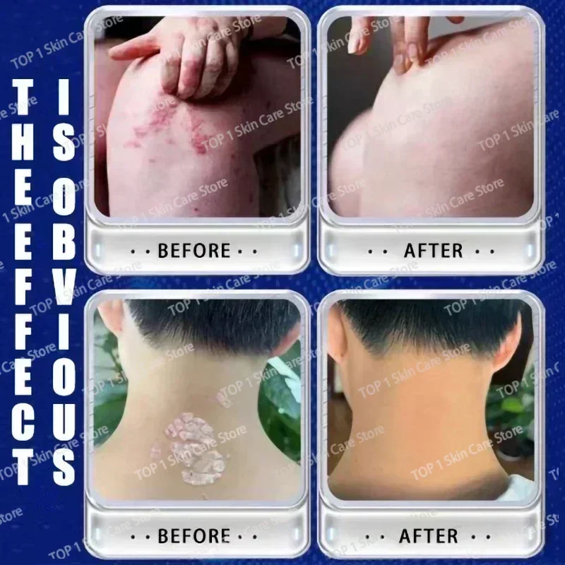 Лидер продаж крем для удаления псориаза экземы лучшие средства против дерматита