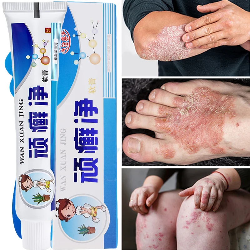 

25g Effective Antibacterial Psoriasis Cream Body Anti-itch Relief Dermatitis Eczema Treatment Urticaria Peeling Skin Care Cream