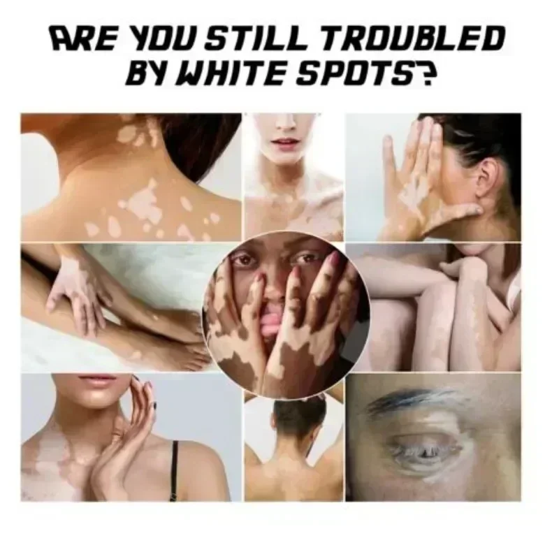 Волшебный инструмент Newvitiligo