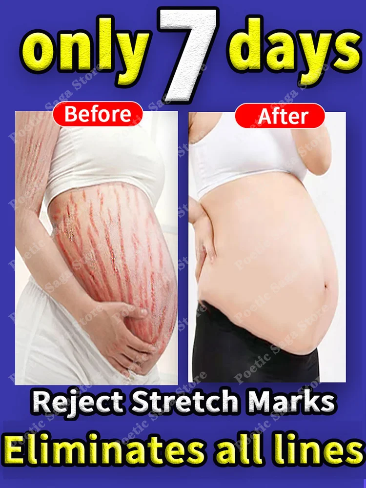 

Effective firming body cream to remove pregnancy scars and stretch marks for maternal repair, anti-aging and anti-acne