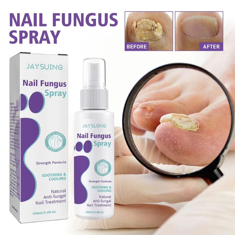 

Sdotter 100ml Effective Anti-Fungal Feet Infections Athlete Foot Nail Fungus Hand And Foot Care Treatment Spray Beauty Health Ca
