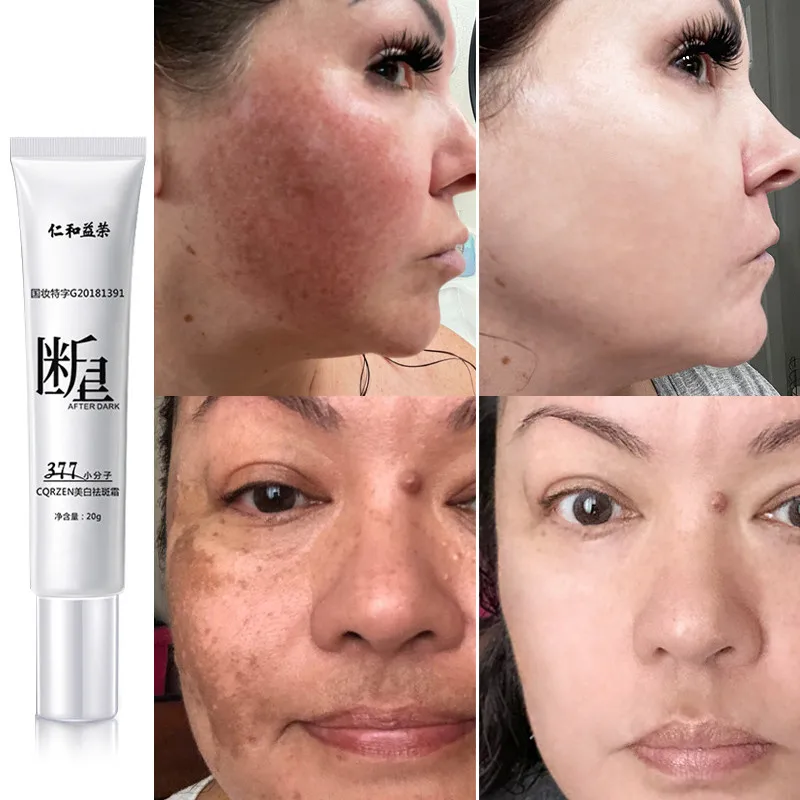 

Lightening Melanin Face Whitening Freckles Cream Remove Melasma Dark Spot Moisturizing Brighten Anti-Aging Skin Care Cosmetics