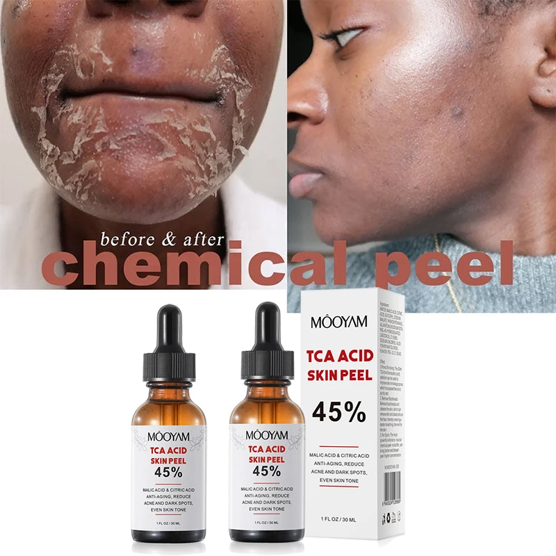 

TCA 45% Chemical Peel Tca Peel Acid Peeling Acid 7-15 Days Delivered Skin Superforce Peeling Pigmentation Acne Scar BrightenSkin