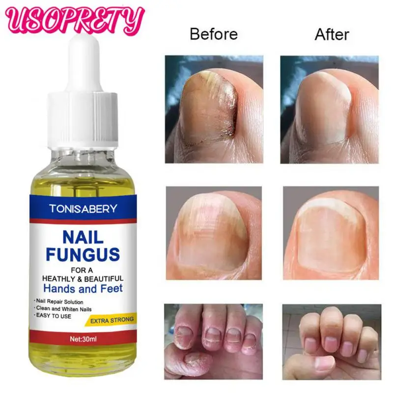 

Сыворотка для удаления серых ногтей, Уход за ногтями, грибок для ногтей, уход за паронихией и онихомикозом